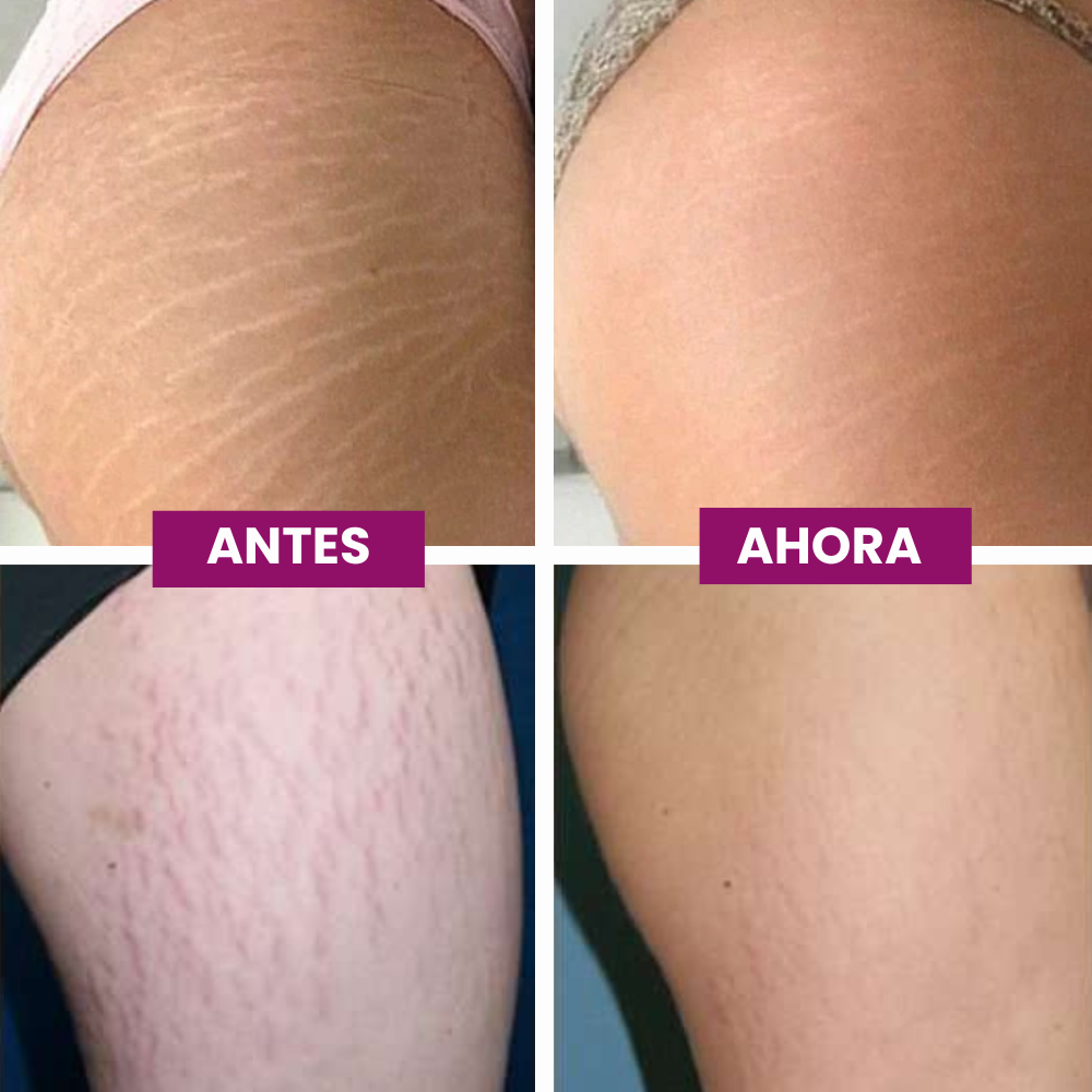Tratamiento intensivo contra estrías Adeus™
