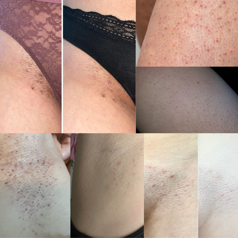 Peach Slices Roll™ - Tratamiento post depilación