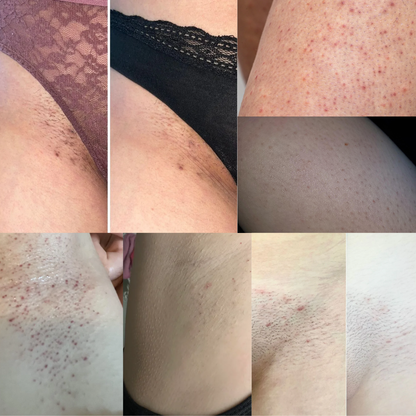 Peach Slices Roll™ - Tratamiento post depilación